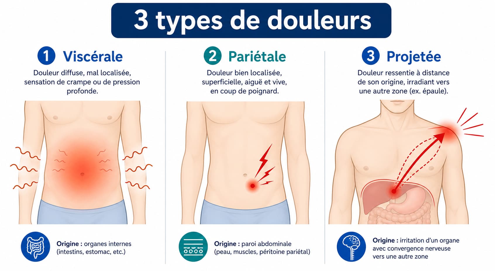 Infographie comparant les trois types de douleurs abdominales : viscérale, pariétale et projetée