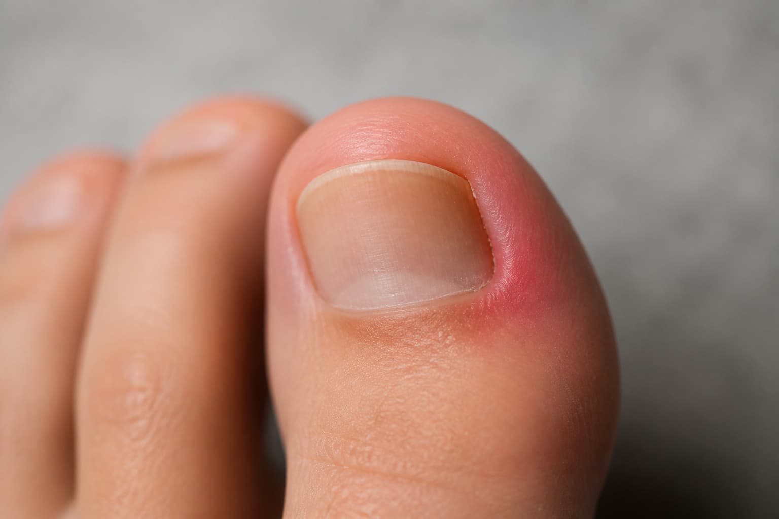 Gros plan sur un gros orteil présentant un ongle incarné : le bord de l